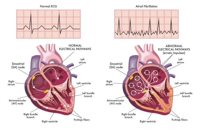 An atrial dysrhythmia originates from