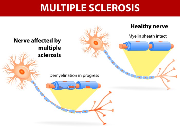 All of the following are autoimmune diseases except