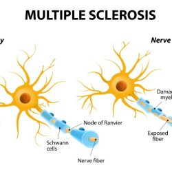 Multiple sclerosis ms discovery promising nervous system brain research symptoms acupuncture medicalnewstoday immediate numbness attention comments complications downloads demotix public