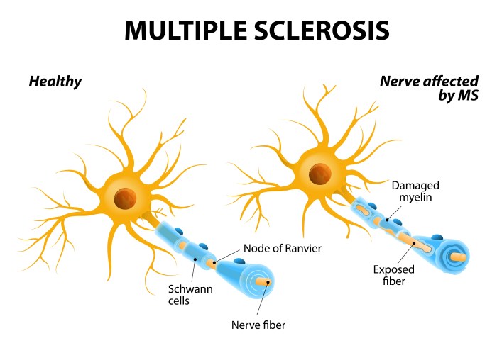 Multiple sclerosis ms discovery promising nervous system brain research symptoms acupuncture medicalnewstoday immediate numbness attention comments complications downloads demotix public