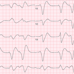 Pac atrial premature pacs contractions dysrhythmia cardiac heartbeats return originating