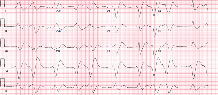 Pac atrial premature pacs contractions dysrhythmia cardiac heartbeats return originating