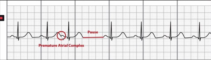 Atrial dysrhythmia