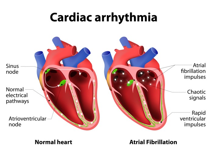 An atrial dysrhythmia originates from